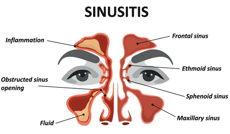 Penyakit Sinus